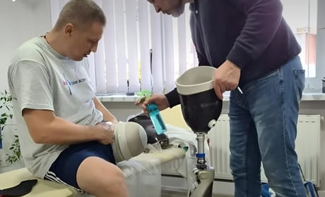 Для складних ампутацій змінюють правила протезування. Що це означає для пацієнтів